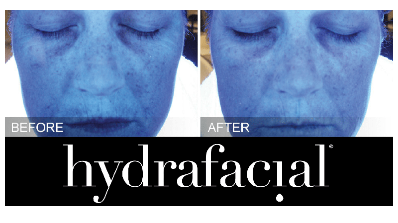 Hydrafacial Deluxe