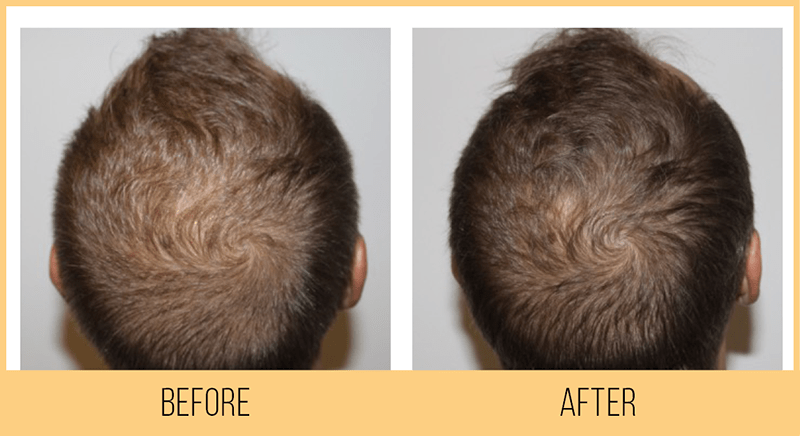 Hydrafacial Keravive