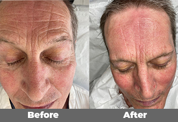 Hydrafacial and Microneedling with the homecare clinicare range