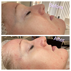 Hydrafacial and Microneedling with the homecare clinicare range