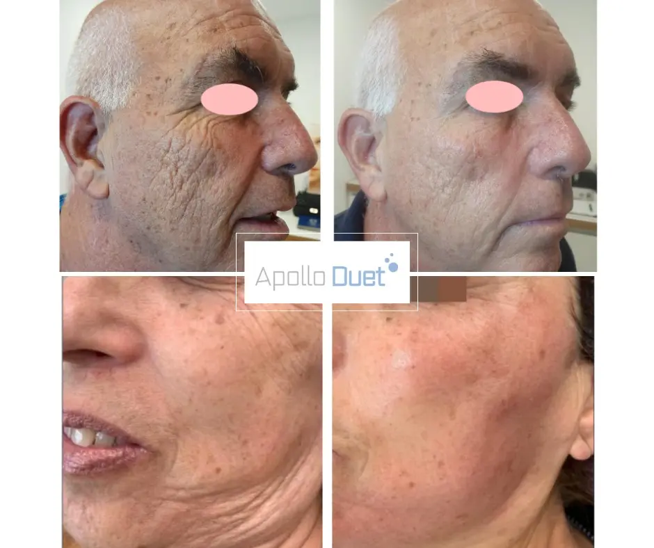 SkinPen Microneedling